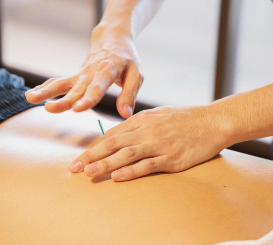 Dry Needling vs Acupuncture