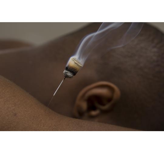 Moxa and Moxibustion