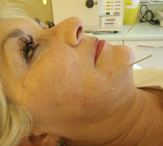 Treating Temporomandibular Joint disorder and Trigeminal Neuralgia with acupuncture